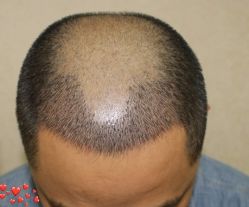 -大麦微针植发丨全国连锁