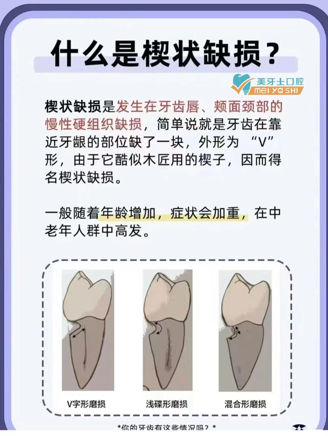 什么是牙齿楔状缺损怎么预防?