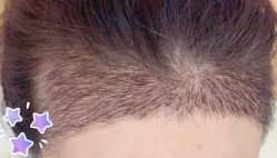 -大麦微针植发丨全国连锁