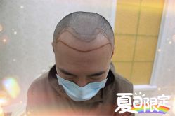 -大麦微针植发全国连锁