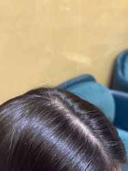 点击看大图 -碧莲盛·不剃发植发