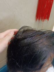 点击看大图 -碧莲盛·不剃发植发