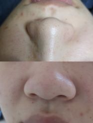 -安那般那皮肤年轻化ANAPANA