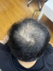 点击看大图 -大麦微针植发全国连锁