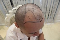 点击看大图 -大麦微针植发丨全国连锁