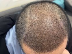 体验后-雍禾植发全国连锁