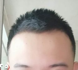 -大麦微针植发丨全国连锁