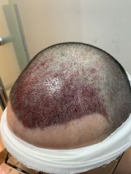 -大麦微针植发全国连锁