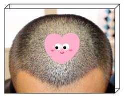 -大麦微针植发全国连锁