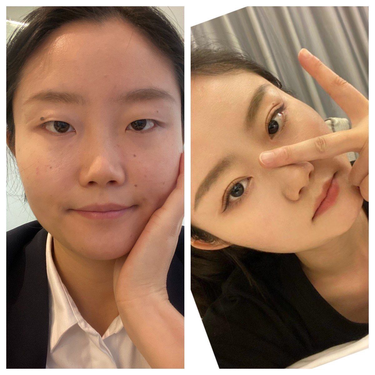 n全切双眼皮后彻底告别小眼睛的焦虑了
刚开始肿胀期每天都在想