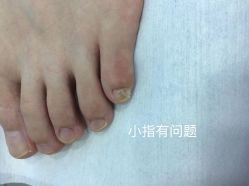-德哥灰指甲脚气甲沟炎跖疣护理