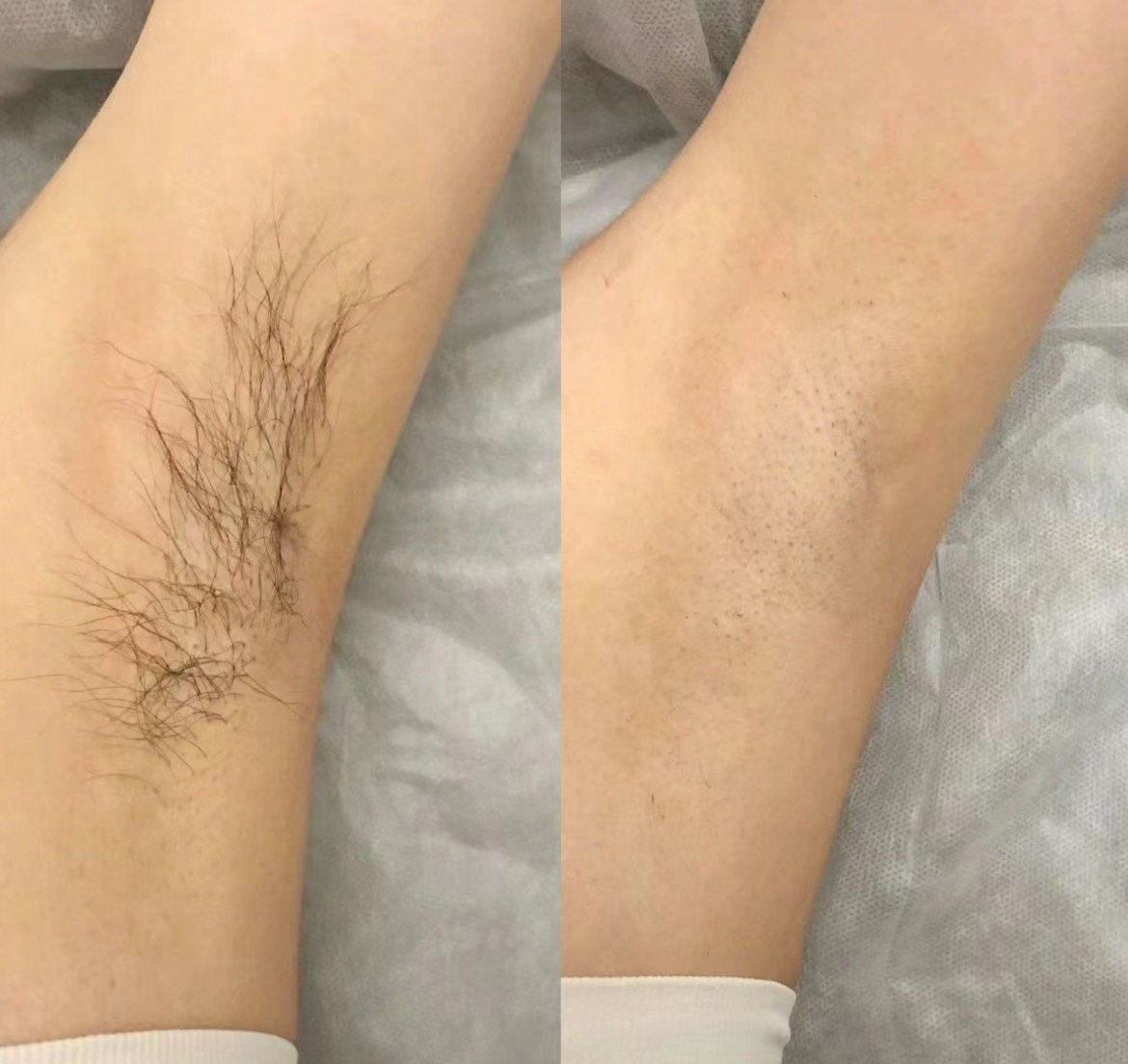 脱毛