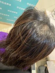 -碧莲盛·不剃发植发