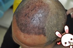 -大麦微针植发丨全国连锁