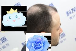 -大麦微针植发丨全国连锁
