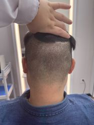 -大麦微针植发全国连锁