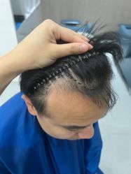 -大麦微针植发全国连锁