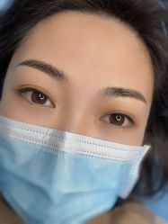 体验后-郡艺医疗美容·微整·眼鼻吸脂