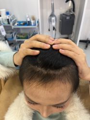 体验后-大麦微针植发全国连锁