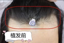 -大麦微针植发全国连锁