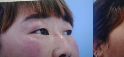 体验前-西安壹加壹医疗美容·西北抗衰旗舰店