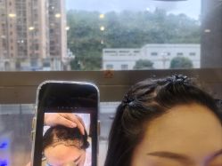 -碧莲盛·不剃发植发