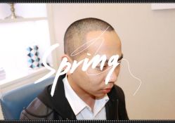 体验后-大麦微针植发全国连锁