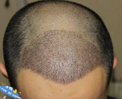 -大麦微针植发丨全国连锁