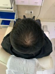 -大麦微针植发全国连锁