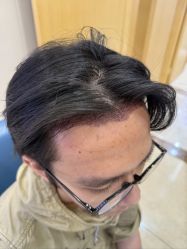 -大麦微针植发全国连锁