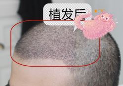 -大麦微针植发全国连锁