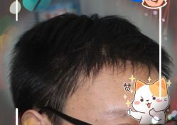 -大麦微针植发全国连锁