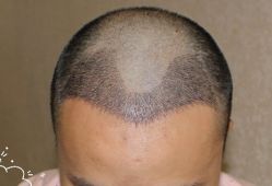 -大麦微针植发丨全国连锁