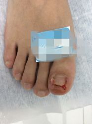 点击看大图 足部美甲-派恩宜灰指甲鸡眼嵌甲手足癣