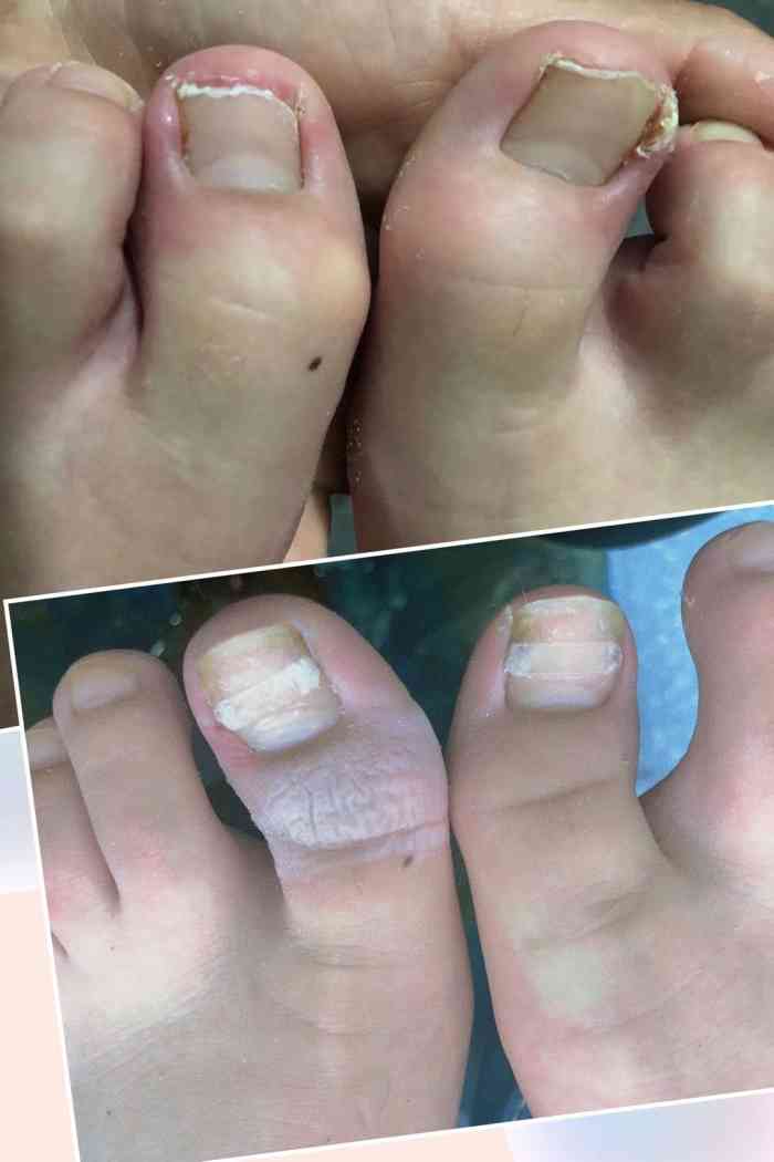 德哥灰指甲甲沟炎跖疣脚气手足癣(三林店)-"手指长了一个灰指甲 让我