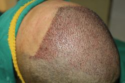 -大麦微针植发丨全国连锁