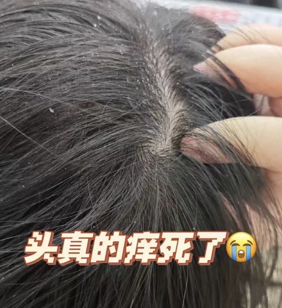 头为什么会痒 头为什么会痒