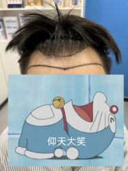 体验前-大麦微针植发全国连锁