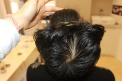 -大麦微针植发丨全国连锁