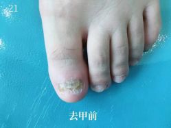 -德哥灰指甲脚气甲沟炎跖疣护理