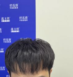 -碧莲盛·不剃发植发