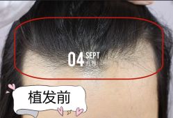 -大麦微针植发全国连锁