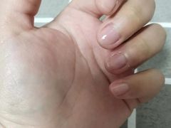 -Andrew指甲专科灰指甲·甲沟炎矫正·3D步态矫形鞋垫定制(浦三路店)