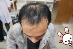 -大麦微针植发丨全国连锁