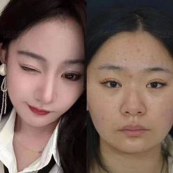 体验后-成都西区医院整形美容
