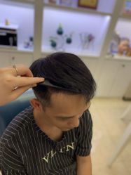 点击看大图 -大麦微针植发丨全国连锁