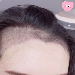 -大麦微针植发丨全国连锁