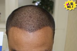 -大麦微针植发丨全国连锁