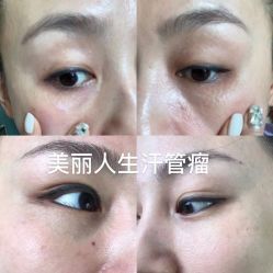 -爱莎扁平疣·汗管瘤·斑痣中心