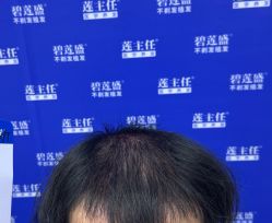-碧莲盛·不剃发植发